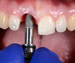 O valor de um implante dentário em São Paulo pode custar de R$ 800,00 a R$ 5.000,00. O valor varia de acordo com o tipo de material e método de implantação.