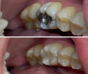 Você tem aquelas restaurações prateadas na boca? Tem vontade de trocar? Hoje em dia é possível fazer isso com restauração em resina e eu vim trazer pra vocês 5 vantagens da resina em relação a restauração de amálgama.