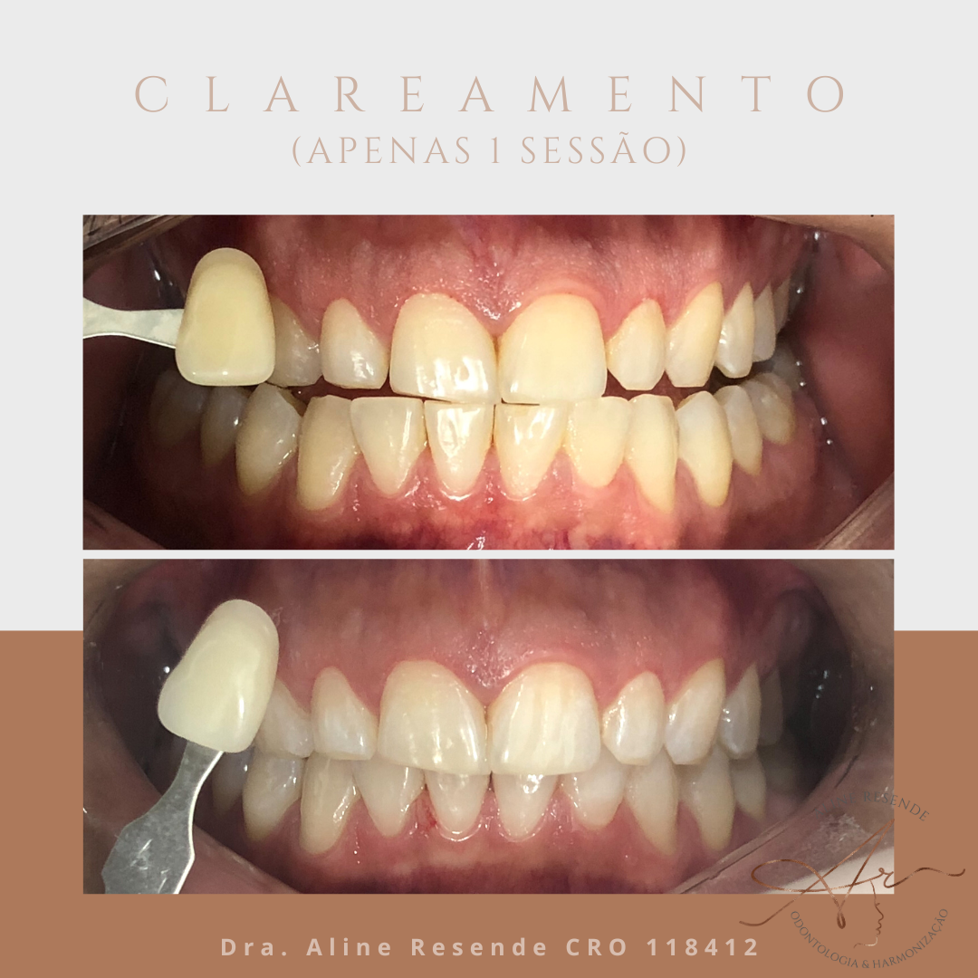 Clareamento caseiro ou no consultório? Existem duas formas de realizar o clareamento dental, seja ele caseiro ou no consultório. E ambas visam elevar a autoestima do paciente.