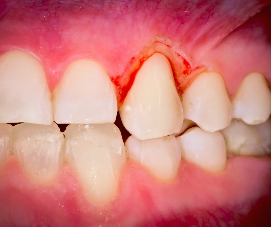 O que causa a gengivite? A gengivite acomete o periodonto de proteção, sendo o primeiro estágio da inflamação periodontal.