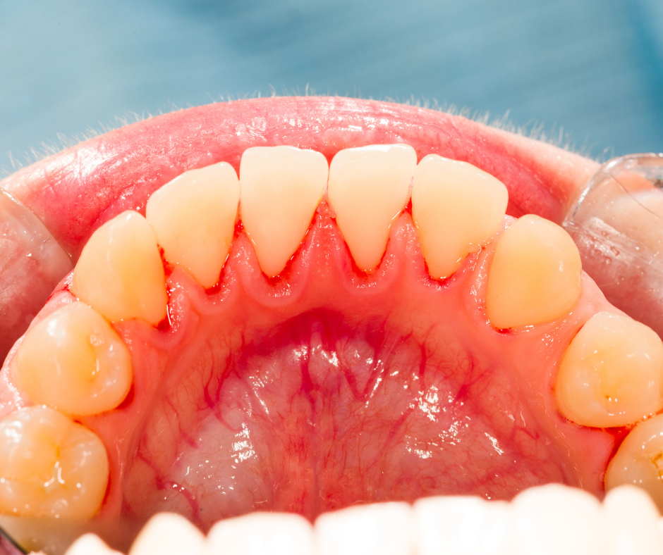A gengivite acomete o periodonto de proteção, sendo o primeiro estágio da inflamação periodontal, causada pela placa bacteriana que se forma na margem da gengiva.