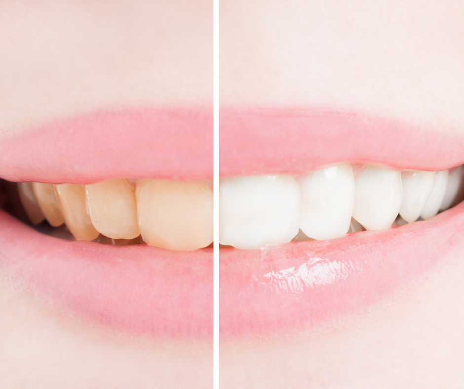 Clareamento caseiro ou no consultório? Existem duas formas de realizar o clareamento dental, seja ele caseiro ou no consultório. E ambas visam elevar a autoestima do paciente.