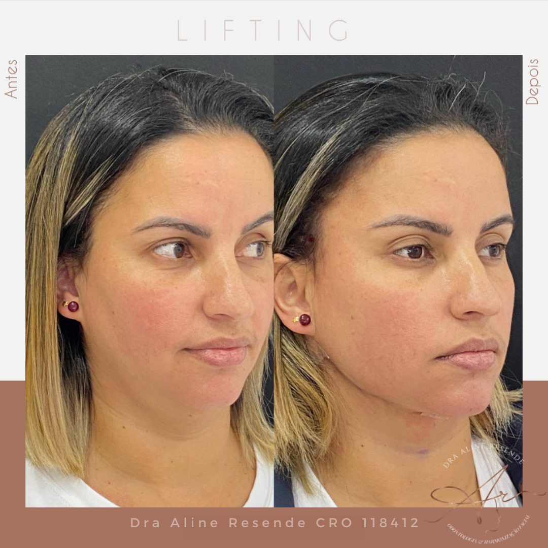 Lifting facial de Fio Definitivo é uma boa opção para quem procura tratamento não invasivo.