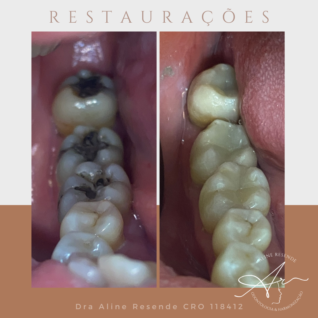 Você tem aquelas restaurações prateadas na boca? Tem vontade de trocar? Hoje em dia é possível fazer isso com restauração em resina e eu vim trazer pra vocês 5 vantagens da resina em relação a restauração de amálgama.