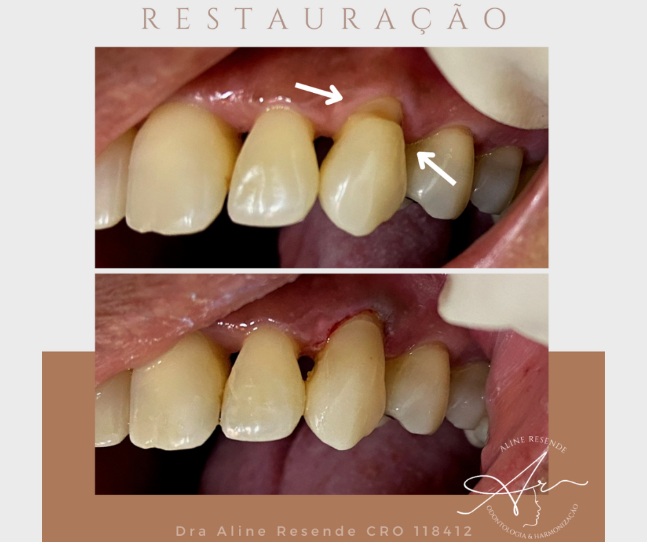 A exposição radicular no dente é uma condição que ocorre quando a raiz do dente fica exposta por causa de uma retração da gengiva.