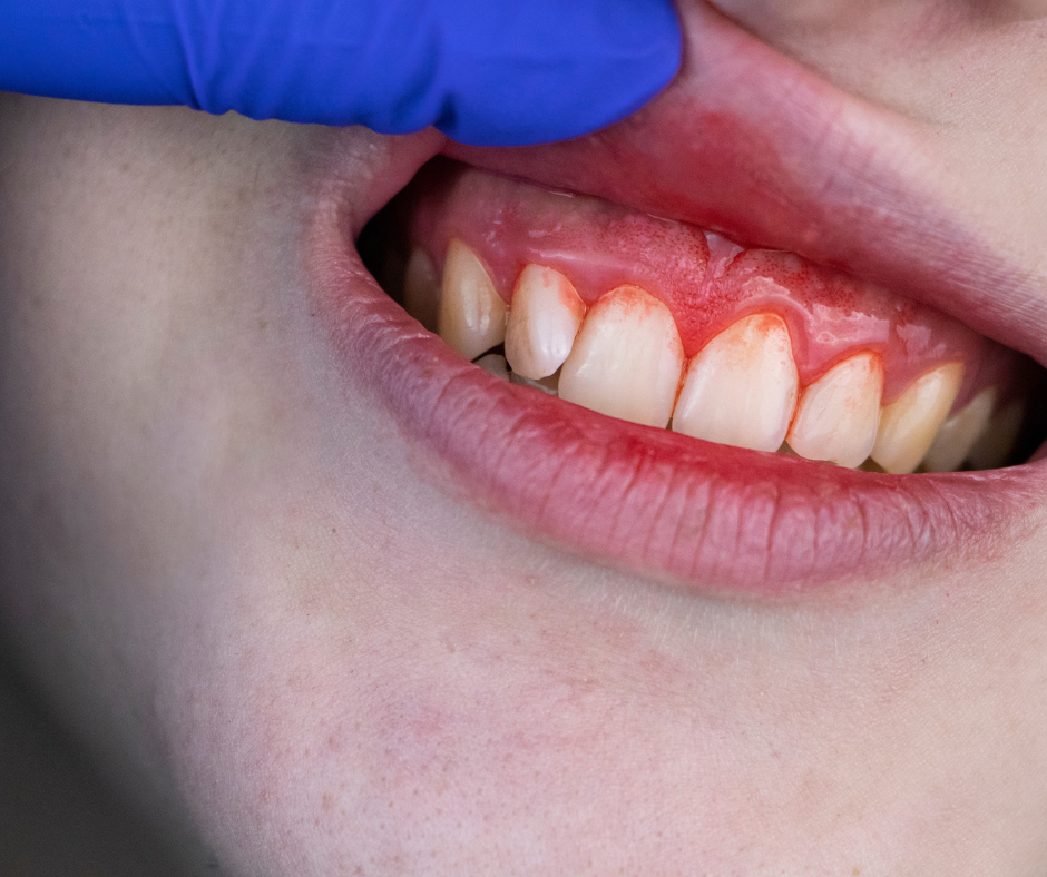 A gengivite é uma inflamação da gengiva causada pela placa bacteriana. A placa bacteriana é uma película pegajosa que se forma nos dentes