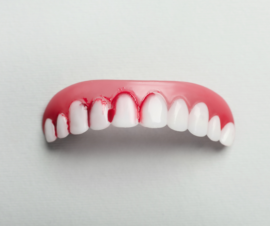 A gengivite é uma inflamação da gengiva causada pela placa bacteriana. A placa bacteriana é uma película pegajosa que se forma nos dentes e contém bactérias que produzem ácido.