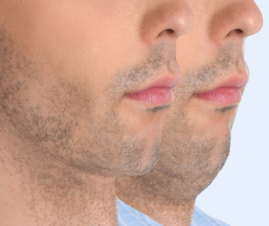 Não há uma resposta única para qual é o melhor procedimento para flacidez facial, pois cada caso é diferente e depende de vários fatores
