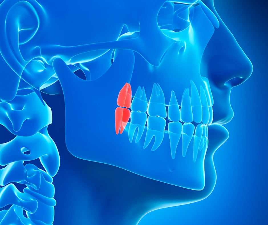 A extração dos dentes do siso é uma intervenção comum na odontologia. Aqui estão informações essenciais sobre a cirurgia.