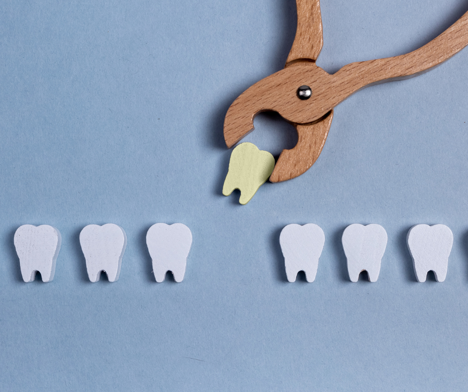 A extração dos dentes do siso é uma intervenção comum na odontologia. Aqui estão informações essenciais sobre a cirurgia.