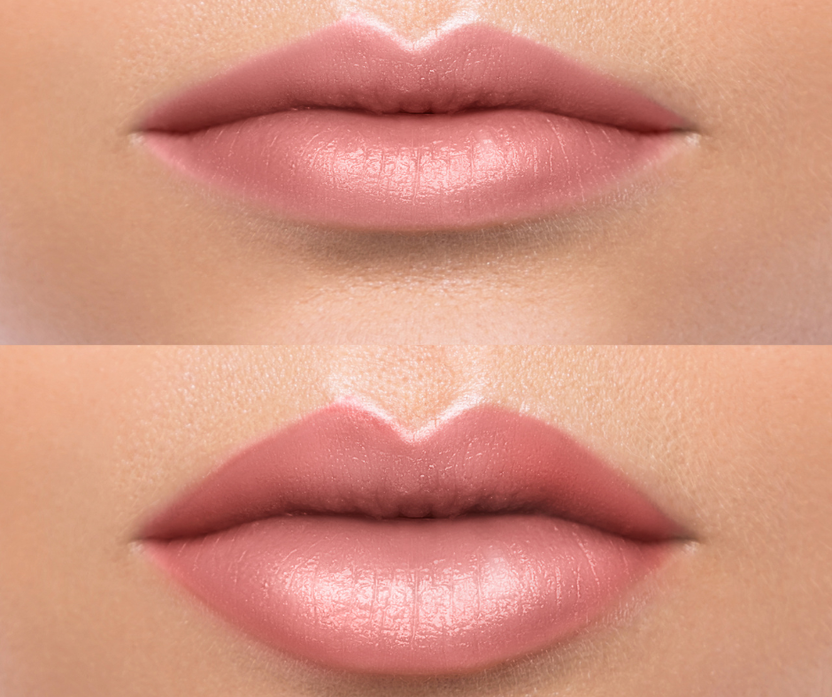 O preenchimento labial com ácido hialurônico oferece uma variedade de funções além do simples aumento de volume.