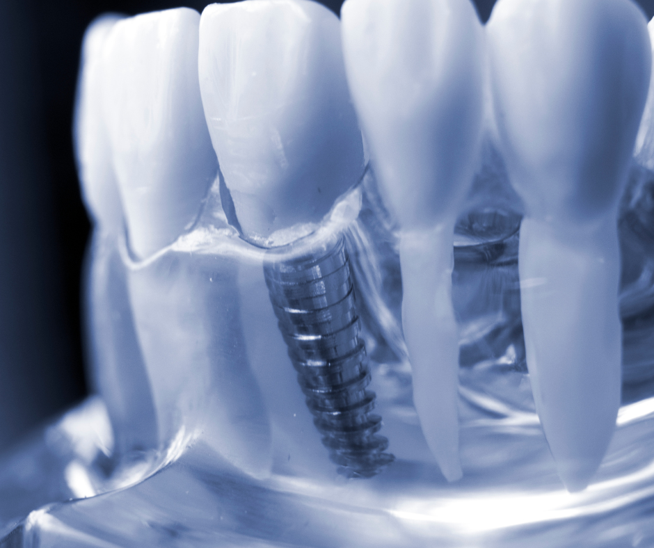 Clínica especialista em implante dentário na Casa Verde, a A.R Odontologia & Harmonização com foco na melhora da qualidade de vida