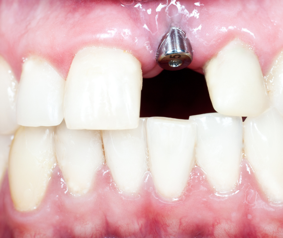 Com alto conhecimento técnico e científico, a Dra. Aline Resende, dentista especialista em implante dentário em SP