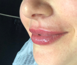 Saiba como dormir após preenchimento labial.Apesar de o preenchimento com ácido hialurônico não ser muito invasivo, ele requer alguns cuidados pós procedimento. Saiba mais!