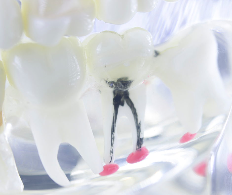 A dentista especialista em canal na Casa Verde, Dra. Aline Resende, é reconhecida por tratar esses casos de fratura dentária ou cáries profundas que necessitam de atenção especial de forma humanizada e indolor.