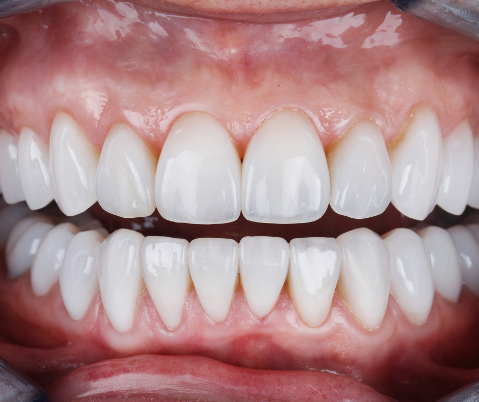 Benefícios das Lentes de contato Dental