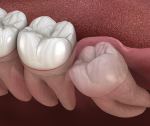 Tirar o siso é indicado sempre que há a presença de dor de dente, dificuldades na mordida, desconforto ou desalinhamento dos molares.