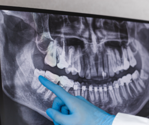 O dentista para arrancar dente do siso em SP é bucomaxilofacial ou um cirurgião-dentista que tenha experiência na realização deste procedimento.