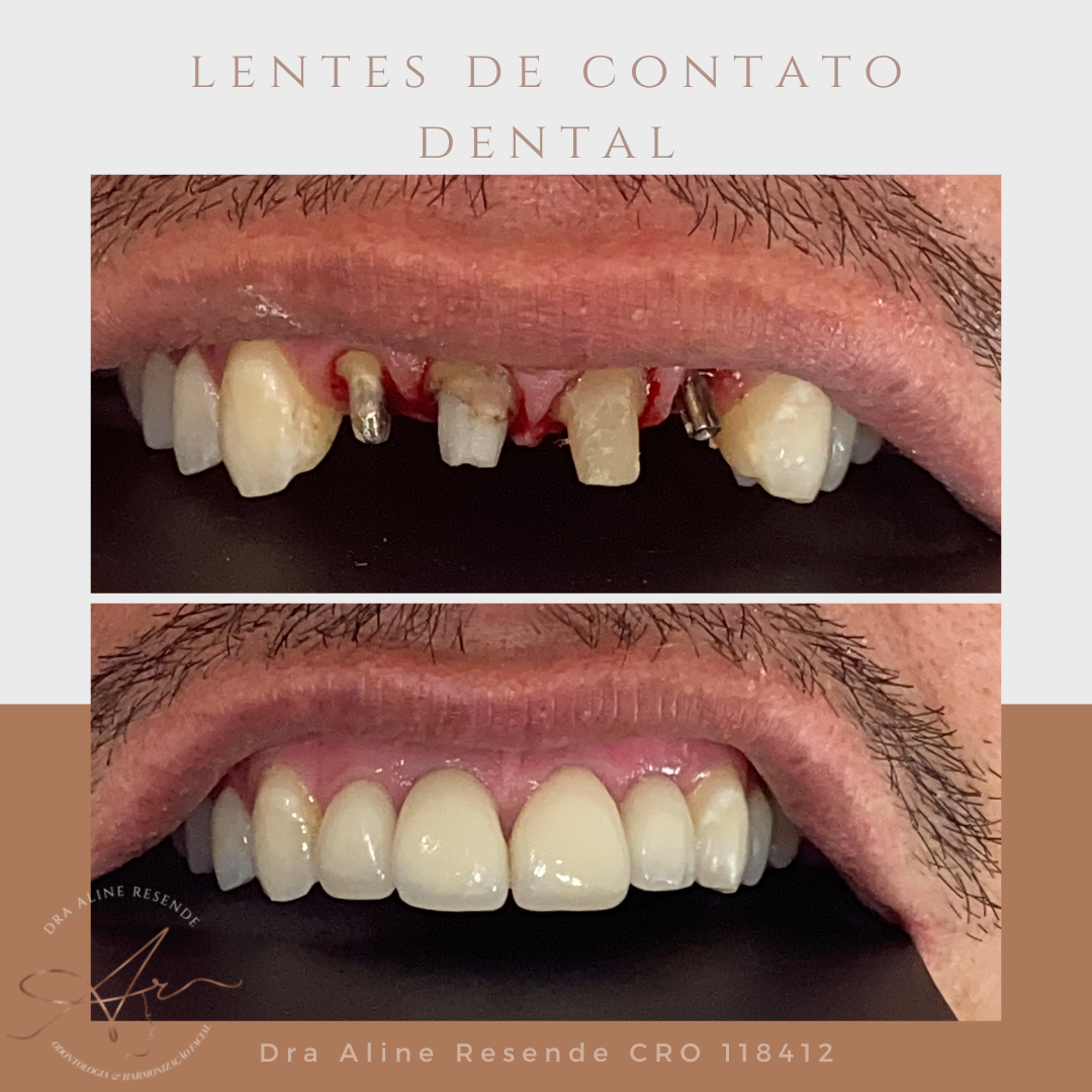 A lente de contato dental pode ser utilizada para diversas situações, como no fechamento de diastema (área de espaço extra entre dois ou mais dentes), na alteração do formato dental e no aumento de proporção dos elementos dentários. 