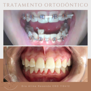 A Clínica A.R oferece tratamento especializado com ortodontista em São Paulo, para a correção posição dentária e dos ossos maxilares, posicionados de forma errônea.