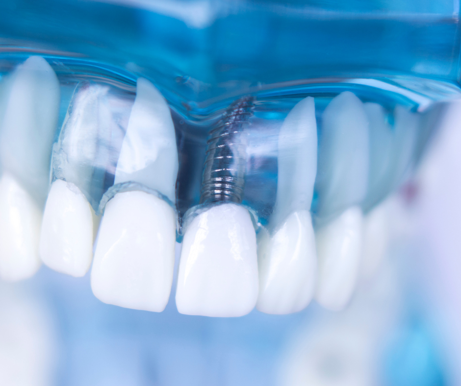 A Clínica A.R Odontologia & Harmonização conta com dentista para implante dentário em SP, referência em resultados naturais