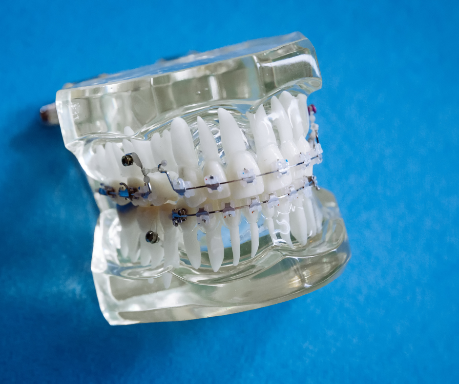 Benefícios da Ortodontia A ortodontia vai muito além da estética do sorriso. Esse ramo da odontologia tem um impacto direto na saúde bucal