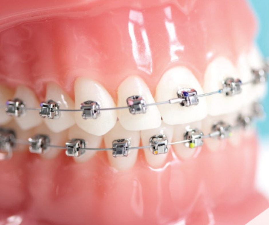 Ortodontia: O Caminho para um Sorriso Radiante. A ortodontia é uma especialidade odontológica que corrige problemas dentários.