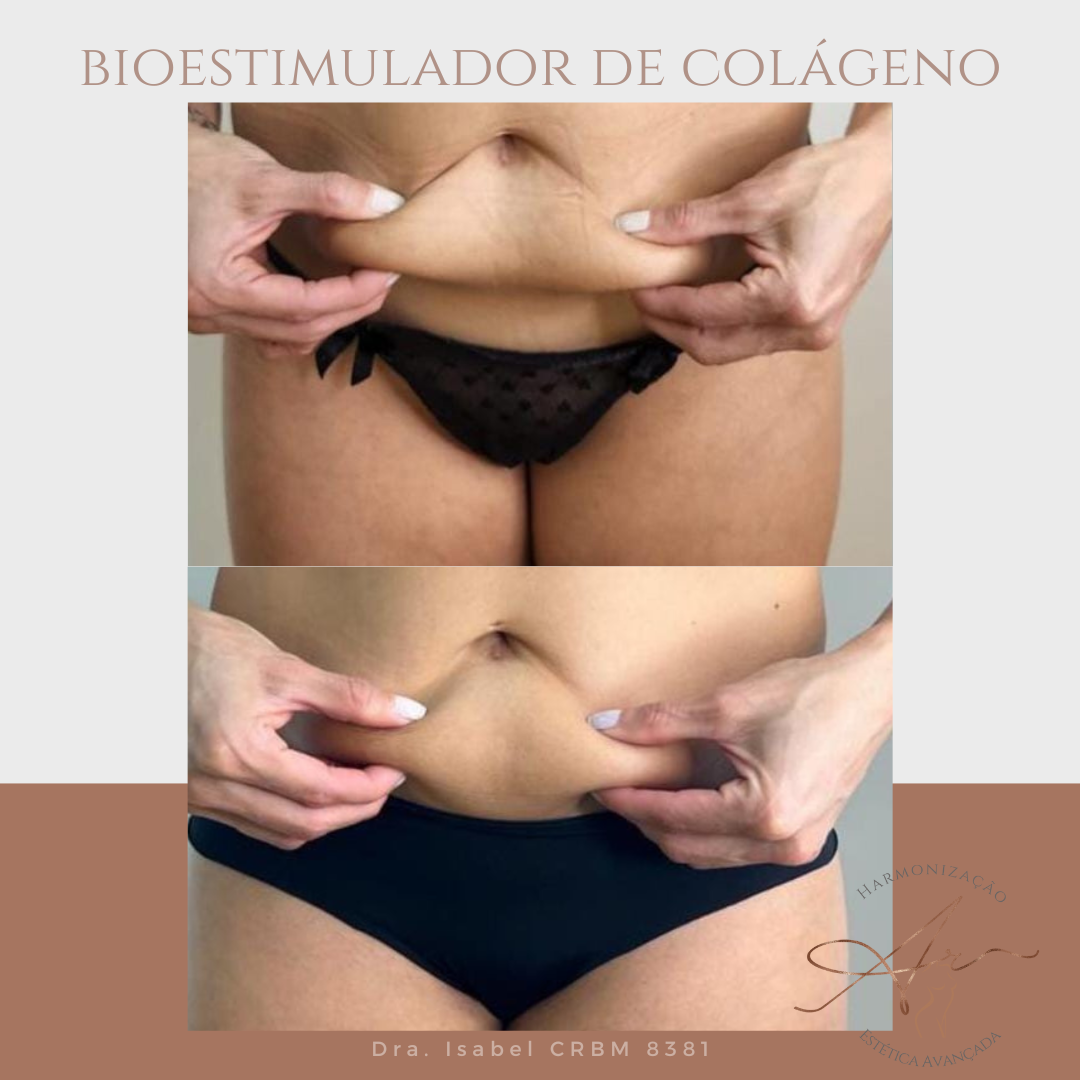Harmonização Corporal Avançada. Quando se fala em harmonização, muita gente pensa só no rosto. Mas você sabia que o corpo também pode