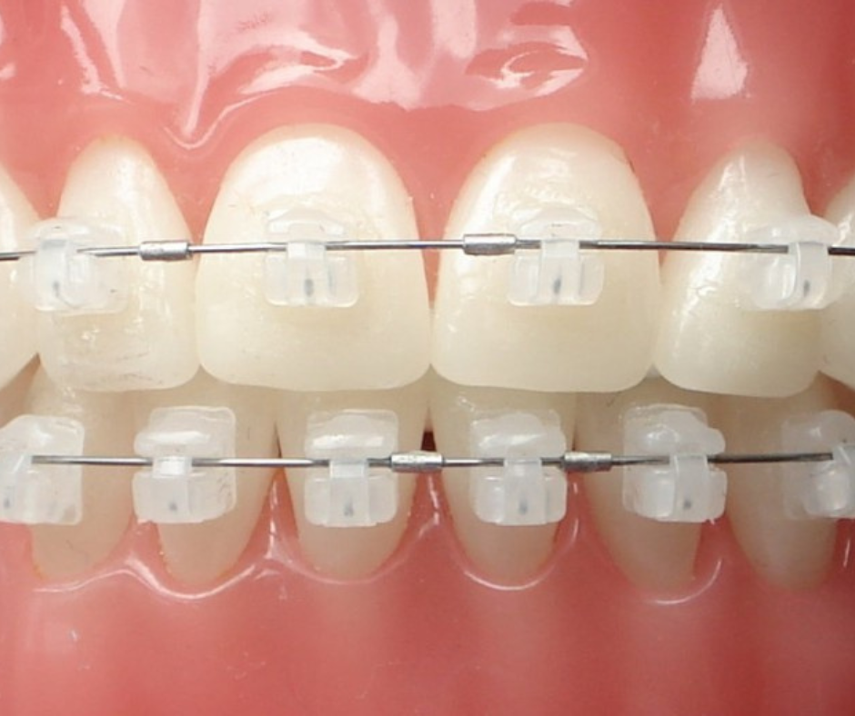 Benefícios da Ortodontia A ortodontia vai muito além da estética do sorriso. Esse ramo da odontologia tem um impacto direto na saúde bucal
