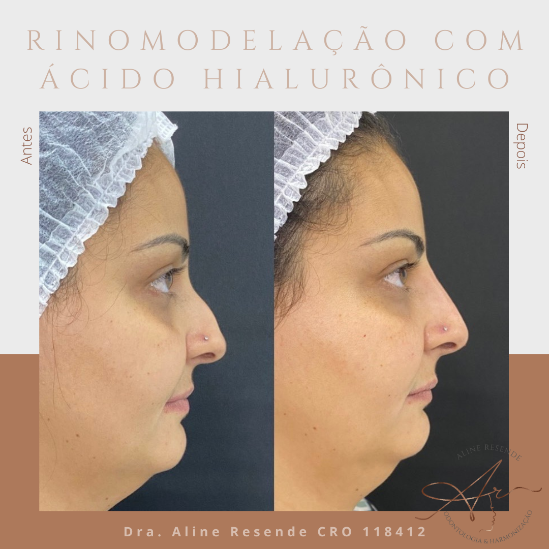 A rinomodelação com ácido hialurônico é um procedimento rápido e simples que fornece resultados comparáveis aos da rinoplastia cirúrgica.