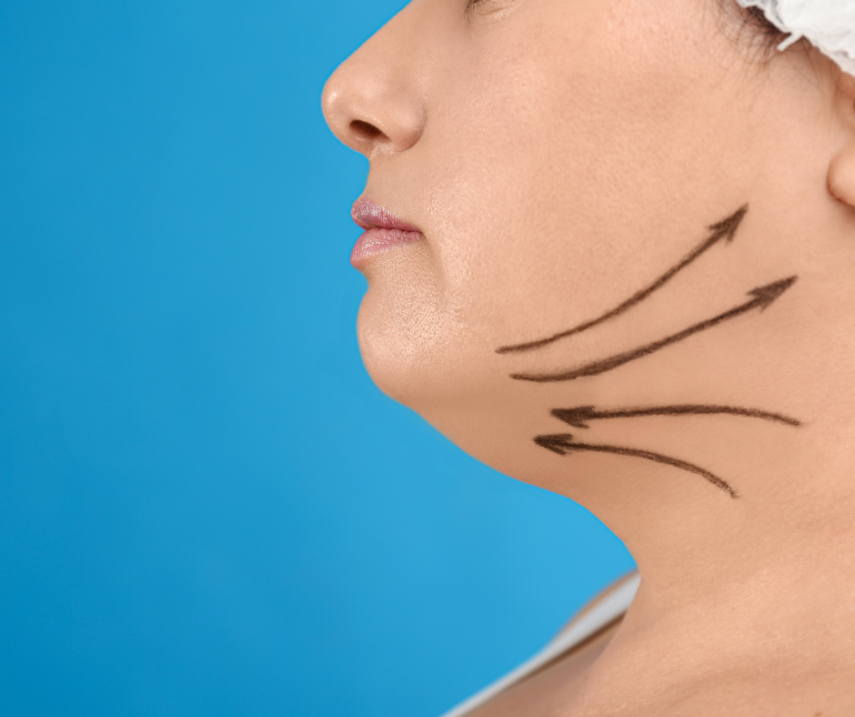 Lifting facial de Fio Definitivo é uma boa opção para quem procura tratamento não invasivo.