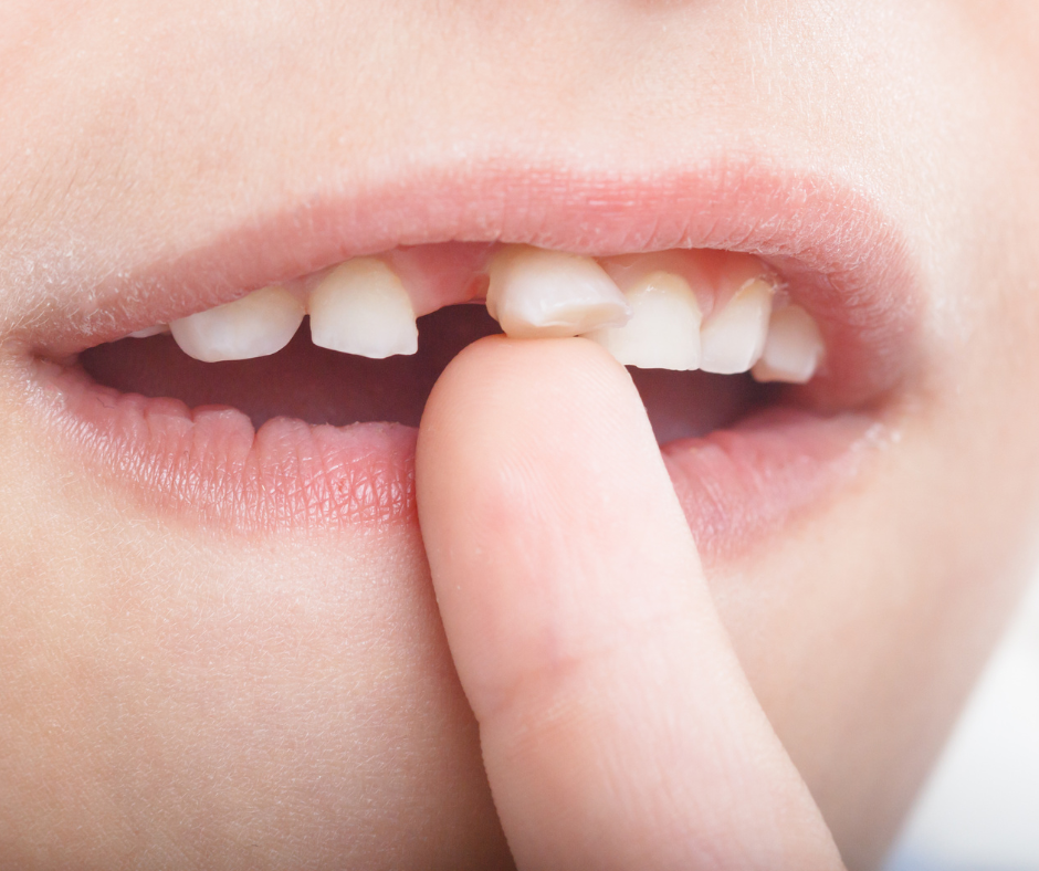 Quando se trata de dentes de leite, existem duas opções principais: deixar o dente de leite cair naturalmente ou extrair o dente de leite.