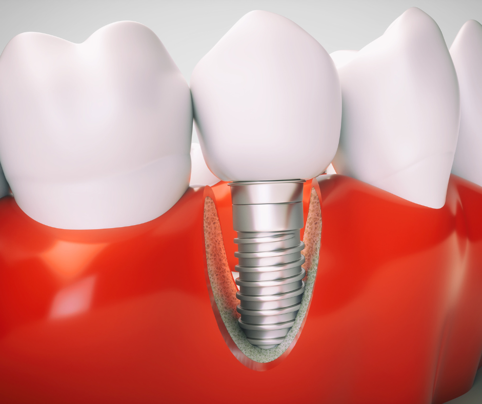 O implante dentário de carga imediata é um procedimento na área da odontologia no qual um implante dentário é instalado