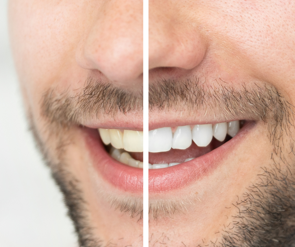 Estética do Sorriso: Como Deixar Seus Dentes Mais Bonitos e Saudáveis. A estética do sorriso vai muito além da beleza.