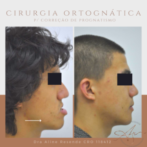 A cirurgia ortognática é um procedimento cirúrgico que busca corrigir problemas de má oclusão dentofacial e desequilíbrios faciais.