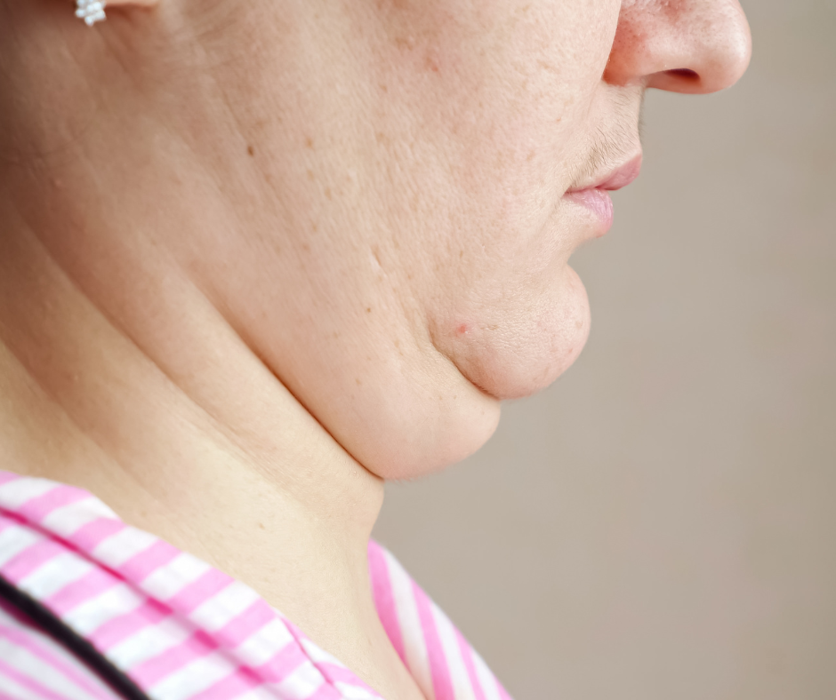 A platismoplastia é um procedimento cirúrgico que visa melhorar a aparência do pescoço, especialmente em casos de flacidez e excesso de pele.