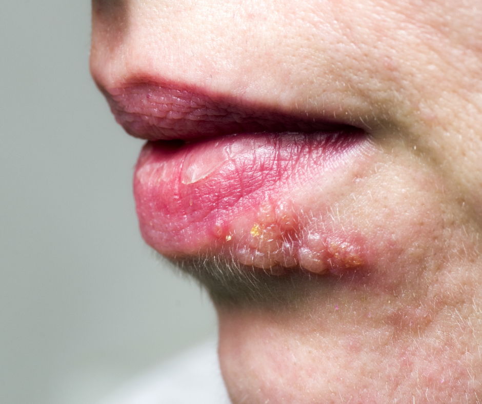 Compreender as causas da herpes é fundamental para sua prevenção e manejo adequado. Aqui estão algumas informações importantes.