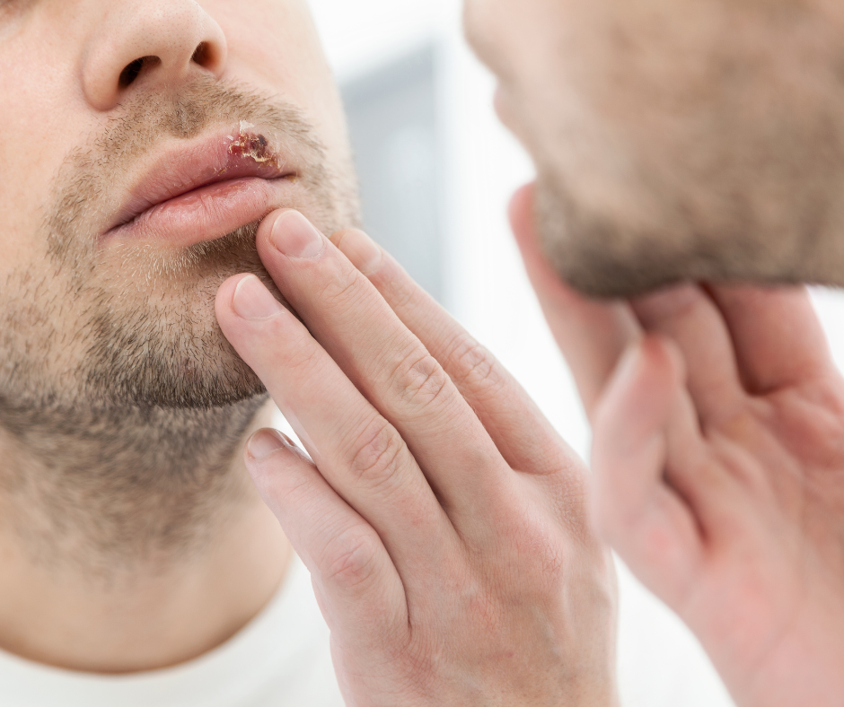 Compreender as causas da herpes é fundamental para sua prevenção e manejo adequado. Aqui estão algumas informações importantes.