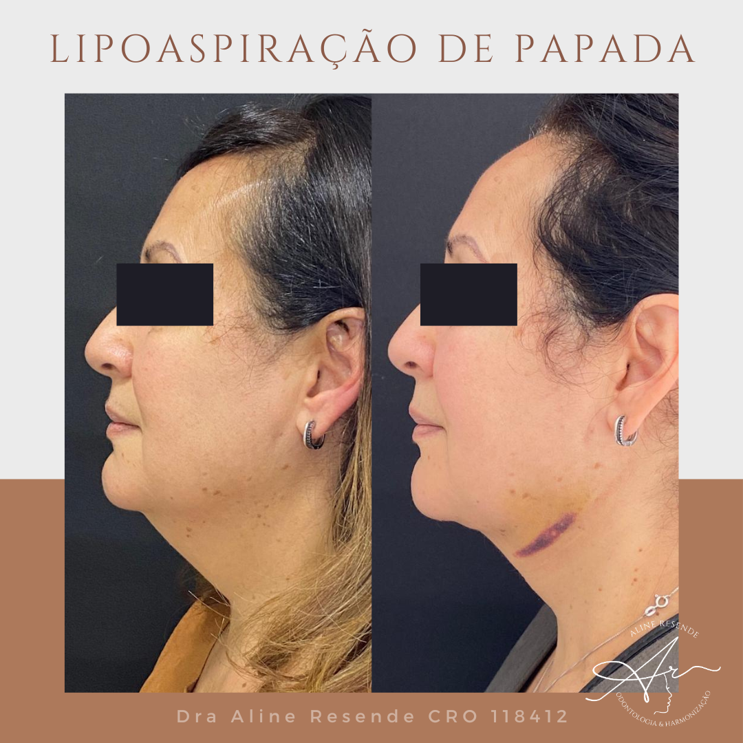 Conheça o nosso Protocolo Slim Face que consiste em 3 procedimentos de redução de gordura e afinamento facial.