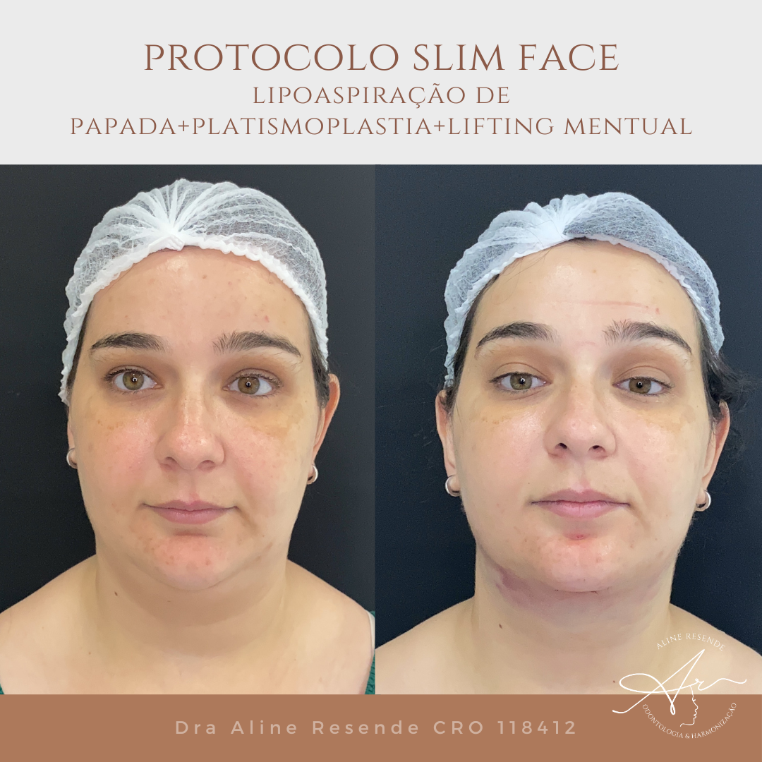 Conheça o nosso Protocolo Slim Face que consiste em 3 procedimentos de redução de gordura e afinamento facial.