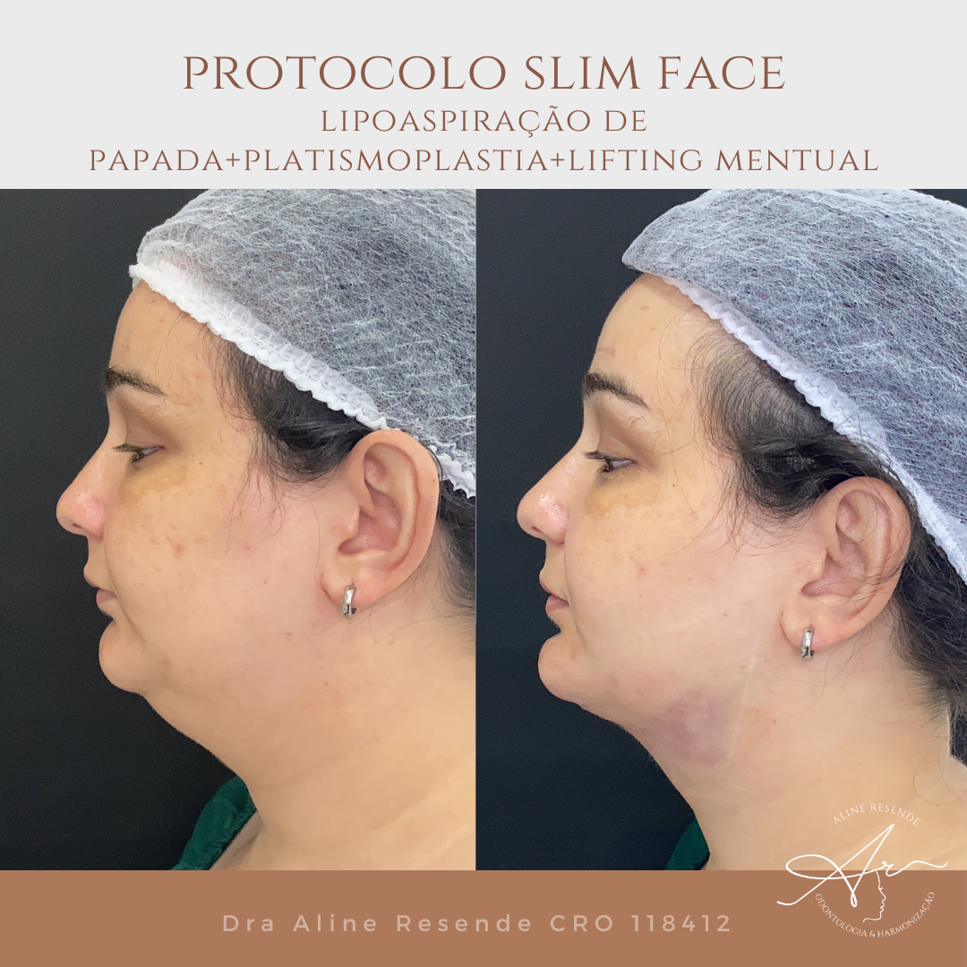 Conheça o nosso Protocolo Slim Face que consiste em 3 procedimentos de redução de gordura e afinamento facial.