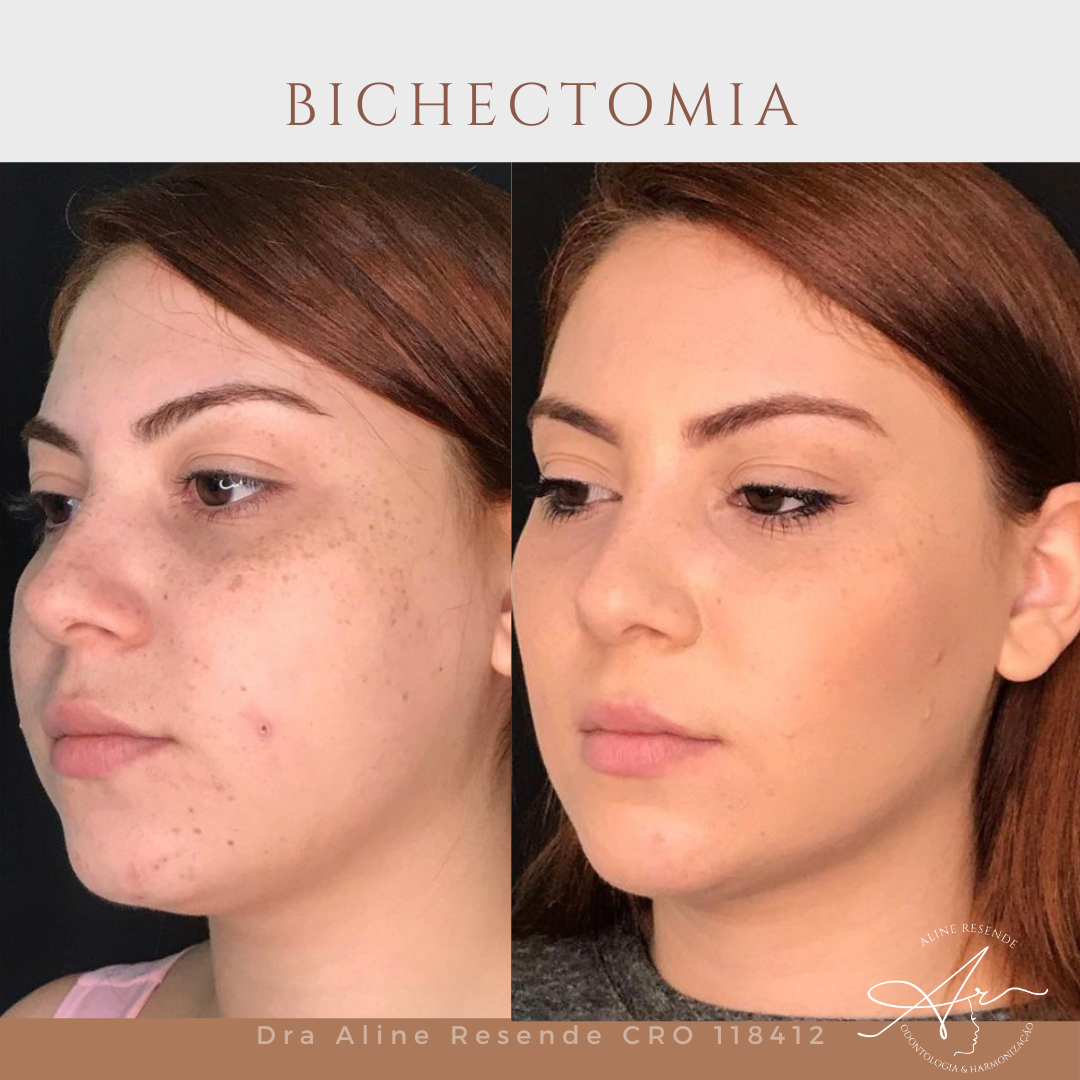 Conheça o nosso Protocolo Slim Face que consiste em 3 procedimentos de redução de gordura e afinamento facial.