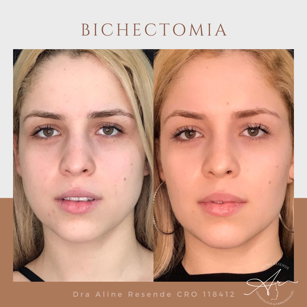 Conheça o nosso Protocolo Slim Face que consiste em 3 procedimentos de redução de gordura e afinamento facial.