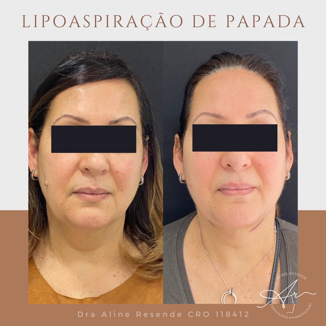 Conheça o nosso Protocolo Slim Face que consiste em 3 procedimentos de redução de gordura e afinamento facial.