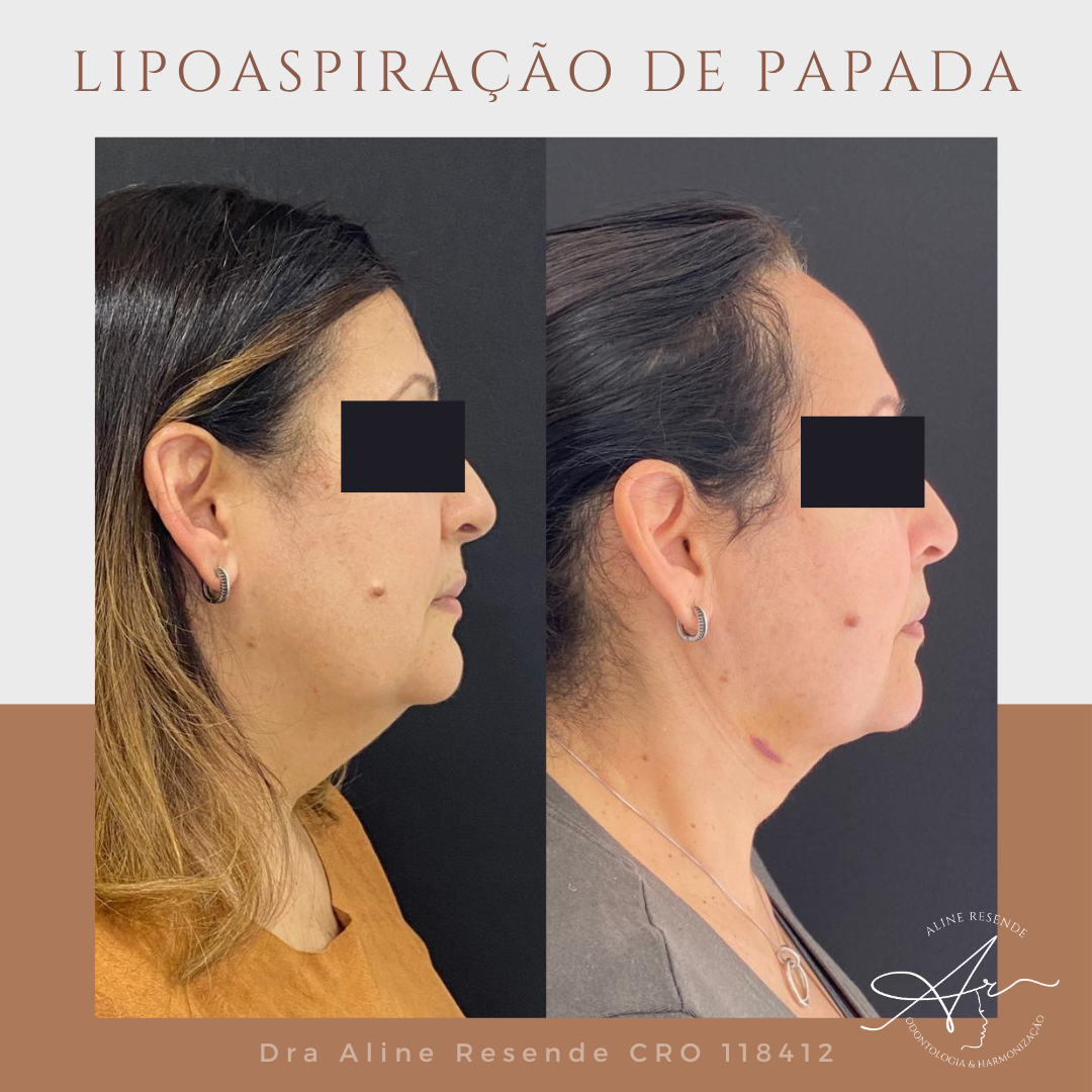 Conheça o nosso Protocolo Slim Face que consiste em 3 procedimentos de redução de gordura e afinamento facial.