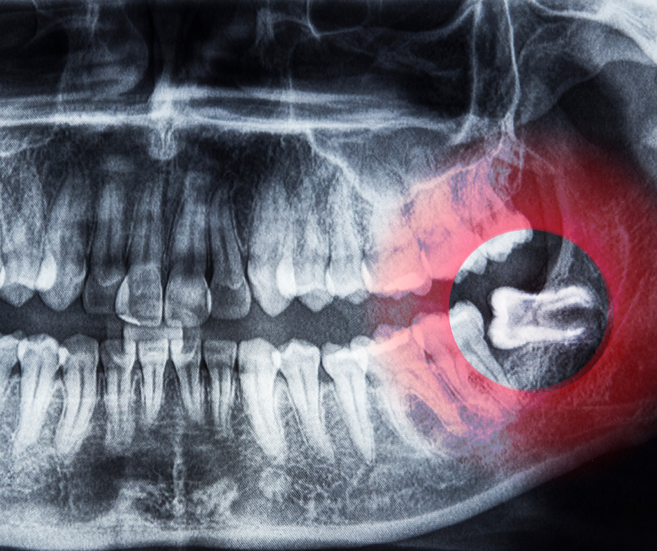 A extração dos dentes do siso é uma intervenção comum na odontologia. Aqui estão informações essenciais sobre a cirurgia.