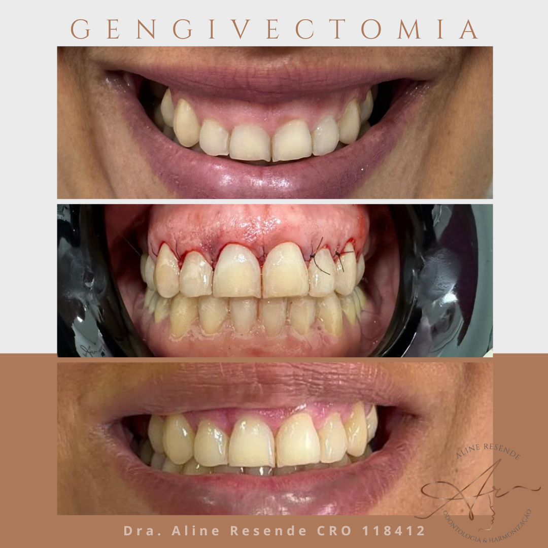 Agendar avaliação com especialista em harmonização facial em São Paulo
Para agendar uma avaliação com a Clínica Aline Resende – Odontologia & Harmonização, basta entrar em contato com a central de atendimento através do WhatsApp 11 97363-8346 ou clique aqui!