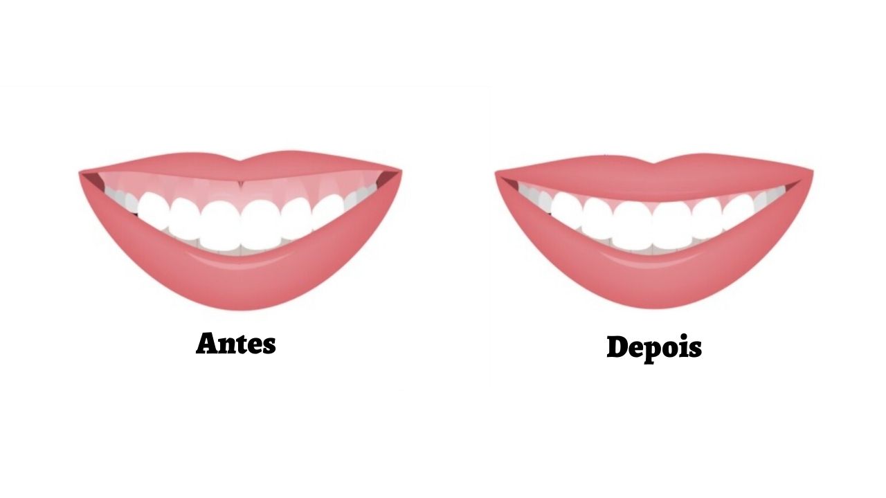 Gengivoplastia x Gengivectomia: Qual é a Diferença? Ambos os procedimentos envolvem a gengiva mas têm objetivos e abordagens diferentes