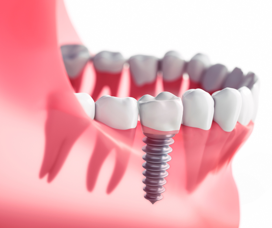 Quanto custa um implante dentário? O implante dentário é uma solução moderna, segura e eficaz para substituir dentes perdidos.
