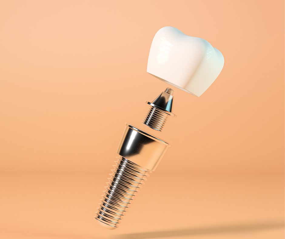 Quanto custa um implante dentário? O implante dentário é uma solução moderna, segura e eficaz para substituir dentes perdidos.